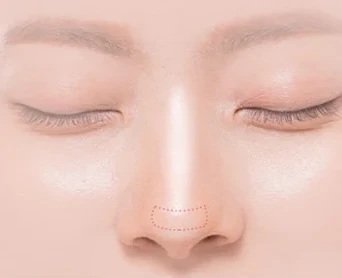 코재수술 원인 — 보형물이 비치는 경우