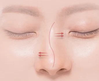 코재수술 원인 — 보형물이 움직인다고 생각되는 경우