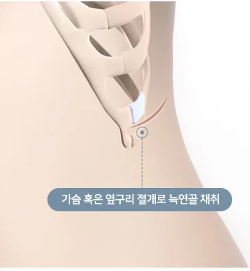 절개 후 늑연골 채취