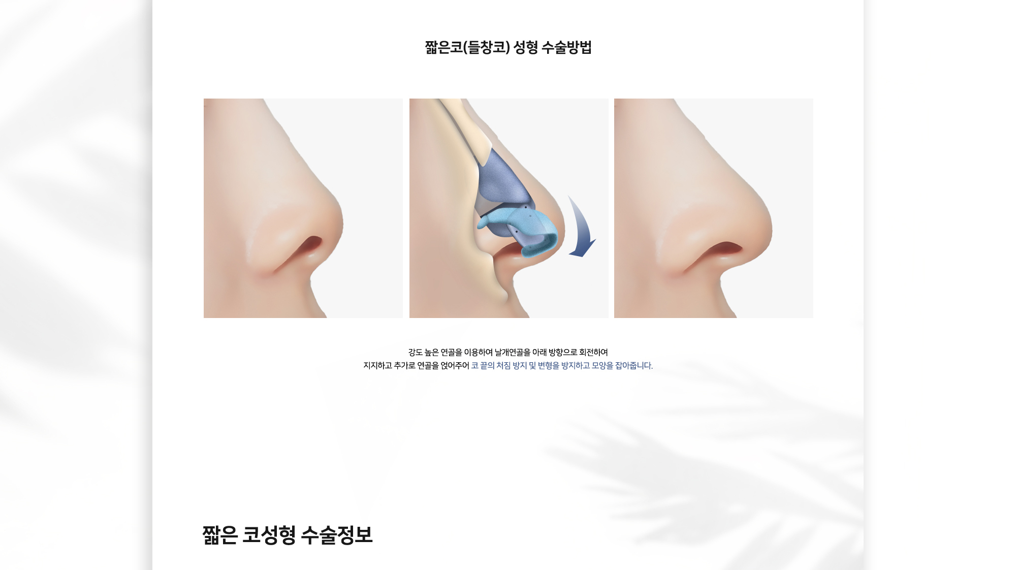 짧은코 성형 수술방법