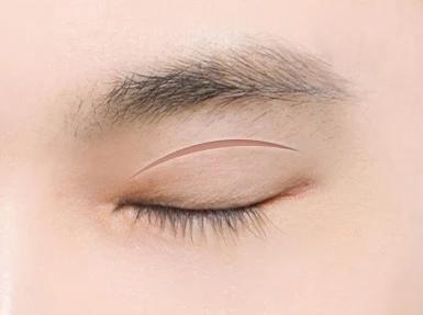 남자눈성형 방법 — 눈매교정
