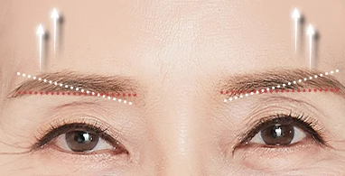 내시경 이마거상 — 눈썹교정
