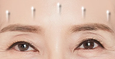 내시경 이마거상 — 주름교정