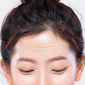 내시경 이마거상 01 헤어라인 최소절개