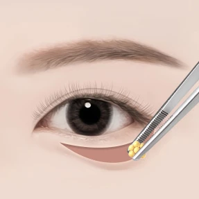 하안검MFL 수술방법 02 당김·고정