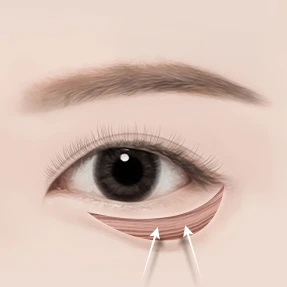 하안검MFL 수술방법 03 봉합