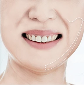 이중턱 실리프팅 02 — 실 삽입