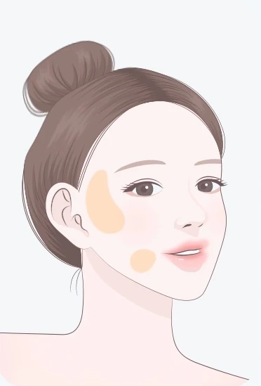 울쎄라 치료 부위 검토 — 옆광대와 볼 주변